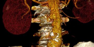 Histórica cirugía aórtica posiciona al ISSSTE de Mérida como referente médico